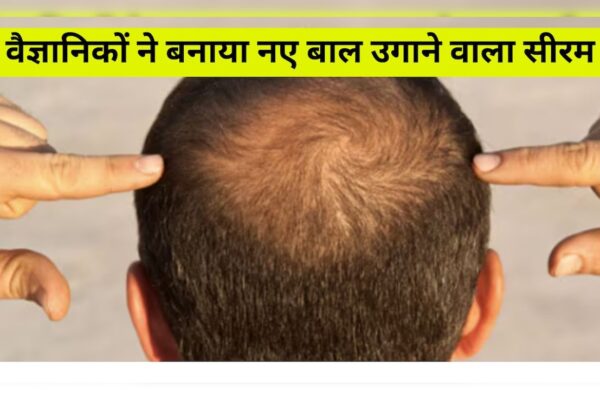 आज की खबर: वैज्ञानिकों का दावा, सिर्फ 20 दिन में गंजी खोपड़ी पर उगेंगे नए बाल, हेयर ग्रोथ के लिए बनाया चमत्कारी सीरम