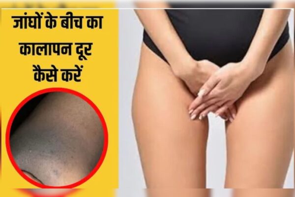 आज की खबर: प्राइवेट पार्ट के कालेपन को कैसे साफ करें? प्राइवेट पार्ट पर क्या लगाना चाहिए डॉक्टर से जानिए