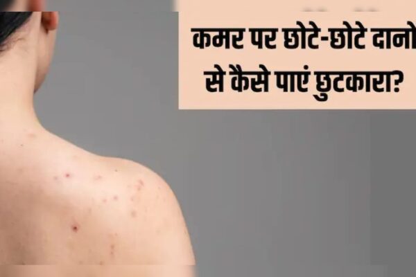 आज की खबर: पीठ पर छोटी-छोटी फुंसी क्यों होती हैं? डॉक्टर से जानें कैसे पाएं Back Acne से छुटकारा