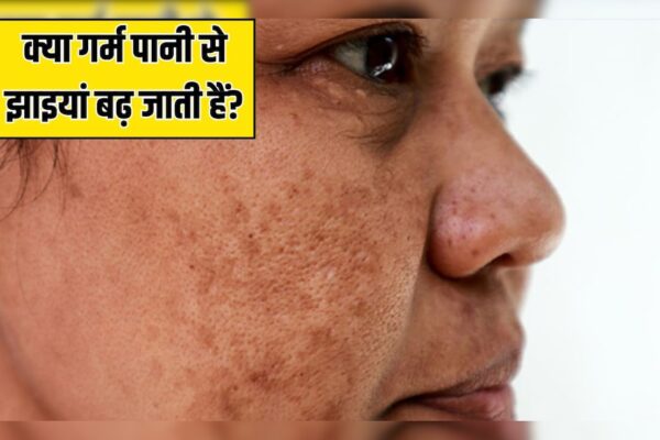 आज की खबर: क्या गर्म पानी में नहाने से झाइयां बढ़ जाती हैं? स्किन की डॉक्टर ने बताया कैसा होगा चेहरे पर असर
