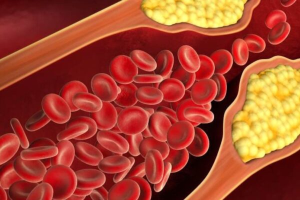 आज की खबर: कोलेस्ट्रॉल को गोली की स्पीड से बढ़ाती हैं आपकी ये गलतियां, काबू पाने के लिए सुबह कच्ची खाएं ये एक चीज