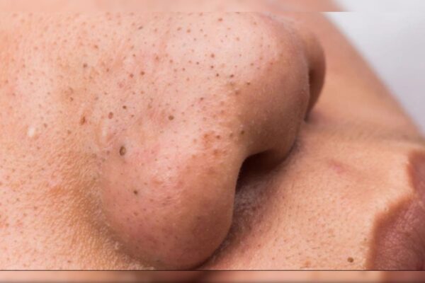 आज की खबर: 5 मिनट में नाक के ब्लैकहेड्स हटाने के घरेलू नुस्खे | Naak Se Blackhead Kaise Hataye
